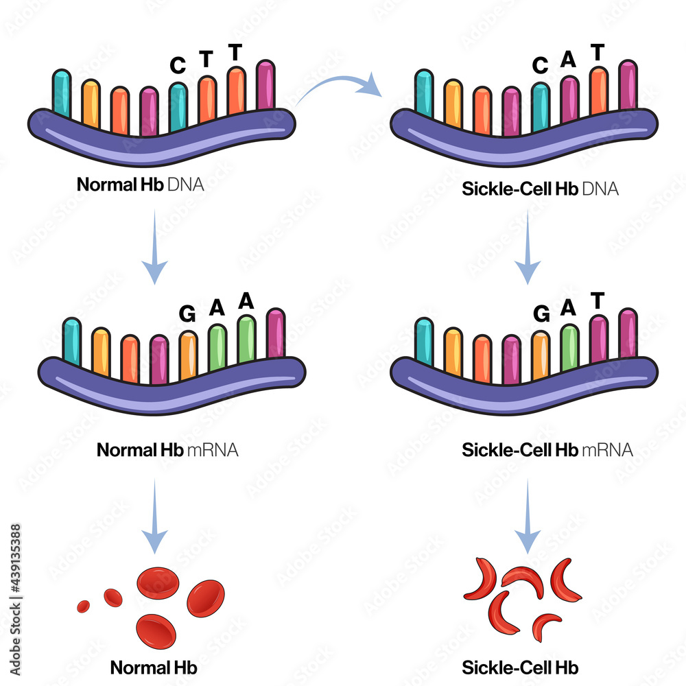 Genetic mechanism or genetics of Sickle cell anemia illustration. Stock ...