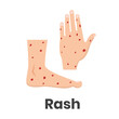 Hemorrhagic rash icon on feet and hands