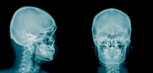 Poster - x-ray image of human skull AP and lateral view in blue tone