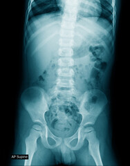 Sticker - x-ray image of human abdomen, picture of human spine and pelvic bone show degenerative change of spine, low back pain and refer pain to lower limb