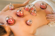 © Irina Efremova/Stocksy - Hijama therapy