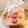 © Irina Efremova/Stocksy - Hijama therapy