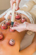 © Irina Efremova/Stocksy - Cupping therapy