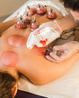 © Irina Efremova/Stocksy - Hijama therapy