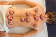 © Irina Efremova/Stocksy - Hijama therapy top view