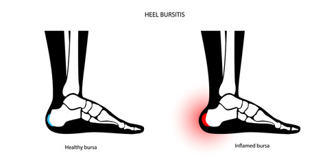 Sticker - Bursitis inflammation concept