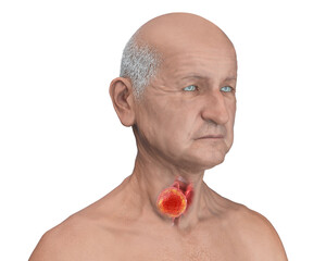 Sticker - Thyroid cancer, 3D illustration showing thyroid gland tumor