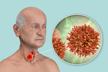 Poster - Thyroid cancer, 3D illustration showing thyroid gland tumor