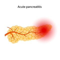 Canvas Print - Pancreas disease and cancer