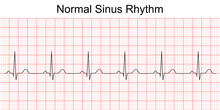 Electrocardiogram Show Normal Heart Beat Line (Sinus Rhythm). ECG. EKG. Vital Sign. Medical Healthcare Symbol.
