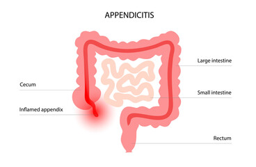 Canvas Print - Appendix pain concept