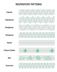 Respiratoy Patterns. Respiratory curves of different situations. Eupnea, hyperpnea, Bradypnea, Tachypnea, Apnea, Cheyne-Strokes, Biot, Kussmaul.   