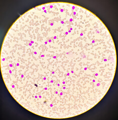 Poster - Photomicrograph of Acute Myeloid Leukemia (AML), Auer rods or Auer bodies present, One type of blood cancer,40x view