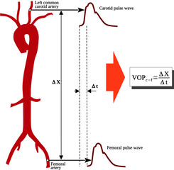Fototapete - pulse wave velocity (pwv) is a measure of arterial stiffness and is defined the velocity at which th