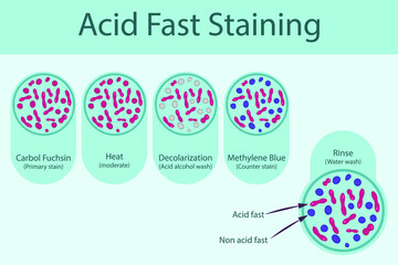 Wall Mural - Acid fast staining technique steps diagram, using Carbol fuchsine and methylene blue vector illustration eps10