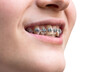 steel dental braces on teeth of upper jaw of girl closeup cutout on white background