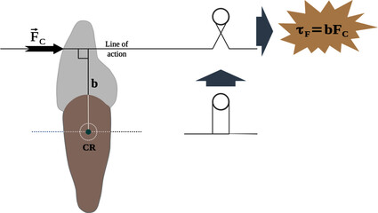 Fototapete - orthodontic forces on the dental crown and the resultant torque