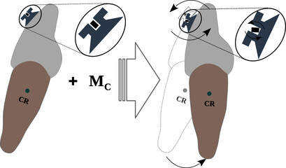 Poster - Torque experienced by a tooth due to the torque in the Bracket slot