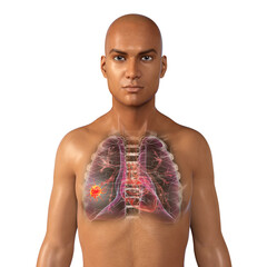 Sticker - Lung cancer, medical concept