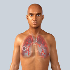 Poster - Lung tuberculosis, 3D illustration