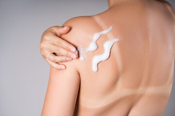 A tanned woman applies sunscreen to her back, sunburn marks on the body