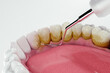 Dental cleaning removing plaque