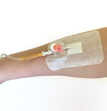  Image Of A Hand With A Catheter. Texture Background Catheter In A Vein In A Patient. A Shot Of Peripheral Venous Catheter In Arm