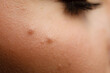 Part of woman face with mole close up