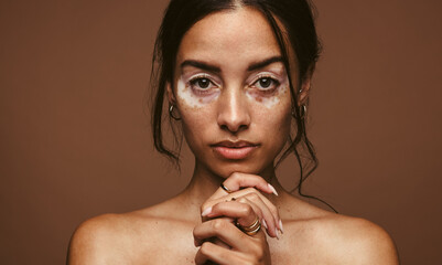 Wall Mural - portrait of woman with vitiligo