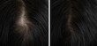 woman head hair baldness before and after treatment