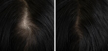 Woman Head Hair Baldness Before And After Treatment
