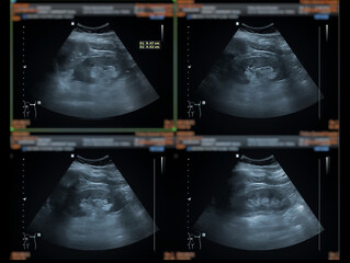 Sticker - Ultrasound upper abdomen showing  Liver, gall bladder and kidney for screening abdominal disease.