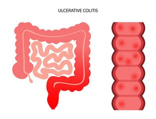 Canvas Print - intestine ulcerative colitis