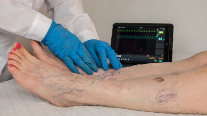 elderly patient at the doctor who checks her legs with many varicose veins