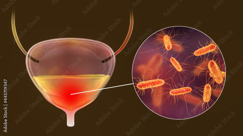 Cystitis, bacterial infection of urinary bladder Stock Illustration ...