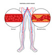 © pikovit - Peripheral artery disease