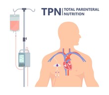 TPN PPN Total Tube Nutritional Partial Line PICC IV Care Unit ICU Tract Enteral Gavage Nose PEG Stomach Surgery System Small Nose Large Food Cancer Eat NG Bowel PEJ Pump
