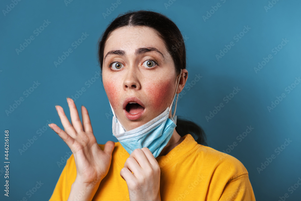 Maskne. Portrait of a young amazed woman shows irritation on her cheeks from wearing a protective mask. Blue background. The concept of rosacea and allergies - obrazy, fototapety, plakaty 
