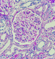 Poster - Photo of glomeruli with segmental endocapillary hypercellularity in patient with IgA nephropathy, magnification 400x, photo under microscope