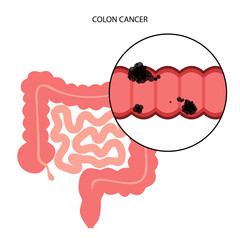 Canvas Print - Colon cancer stage