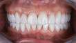 © Dental Pro Content - with veneers on the upper and lower jaw in the bite