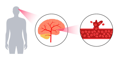 Sticker - Brain stroke hemorrhagic