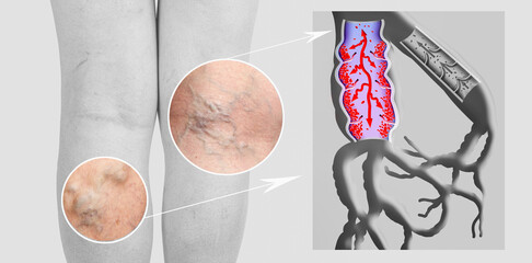 Wall Mural - Varicose veins on a female senior legs. The structure of normal and varicose veins.