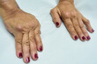 Rheumatoid Arthritis on female hands. Medical themes