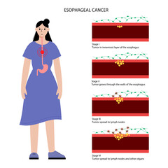 Canvas Print - esophageal cancer stages