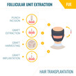 FUE hair transplantation infographics. Male alopecia treatment method. Follicular unit extraction surgery steps. Man with balding head in rear view. Medical vector illustration.