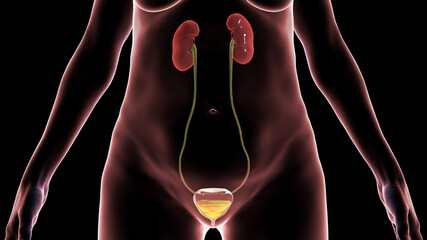 Sticker - Overactive urinary bladder, 3D illustration