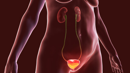 Wall Mural - Overactive urinary bladder, 3D illustration