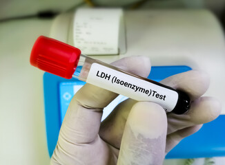 Poster - Blood sample tube for LDH (isoenzyme) test. lactate dehydrogenase, diagnosis for cellular destruction or tissue damage