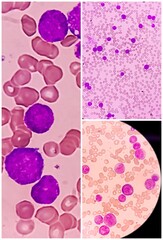 Canvas Print - Acute lymphocytic leukemia (ALL) is a type of blood cancer, blasts or leukemia cells with Thrombocytopenia